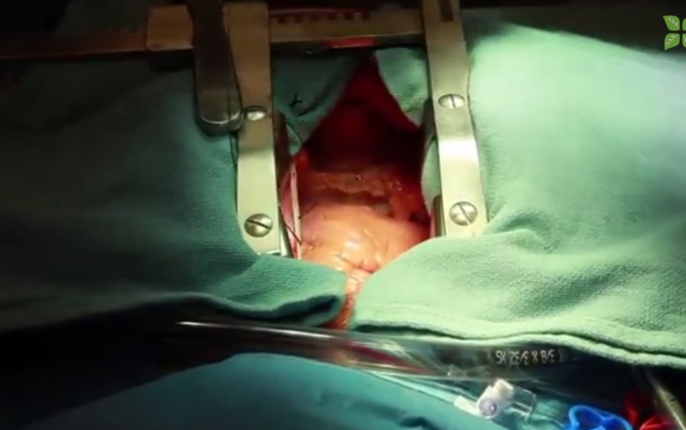 Quer ver um coração batendo em plena cirurgia? [vídeo]