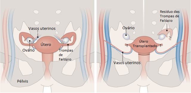 20160459803477 Transplante de útero vira realidade, e agora até os homens podem engravidar