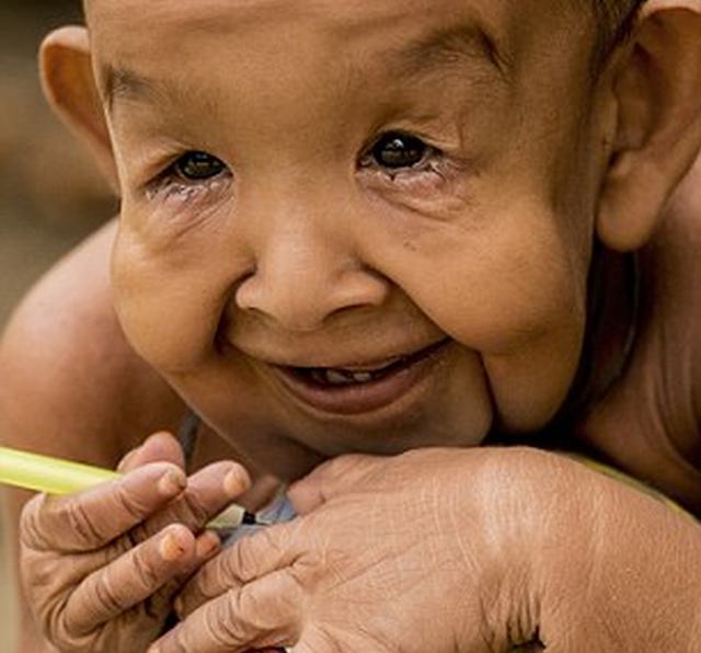 Menino de 4 anos com aparência de idoso abandona escola por causar medo 3 10163407186544
