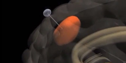 Imagem de: Veja uma "vara de pescar" que entra na cabeça e acaba com o câncer cerebral