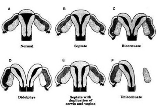 Uterus Didelphys Porn