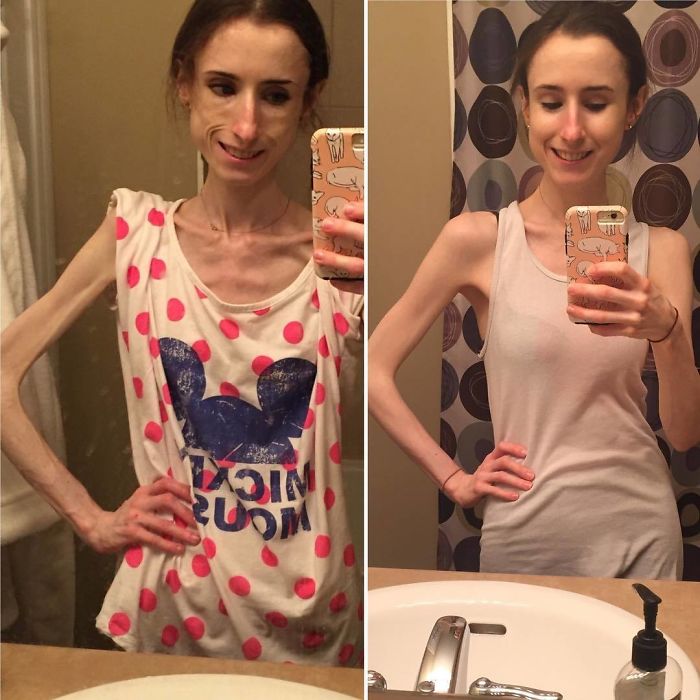 Impressionante: Confira 20 Pessoas Que Conseguiram Vencer A Anorexia ...