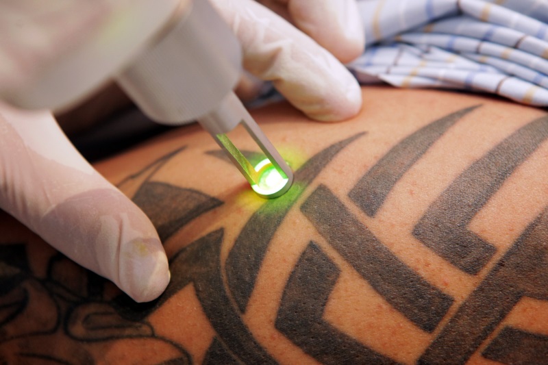 laser remoção tatuagem braço