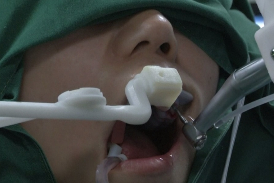 Imagem de: Robô dentista? Aparelho chinês realiza primeiro transplante de dentes