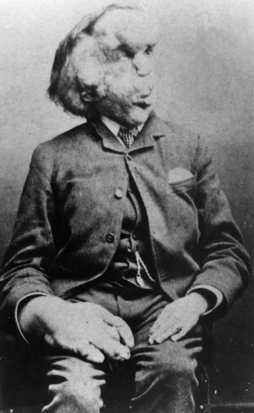 Conheça a trágica história de Joseph Merrick, o “Homem Elefante ...