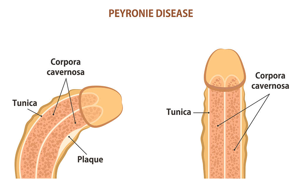 Acúmulo de tecido fibroso pode causar a curvatura do pênis (Crédito: Reprodução )