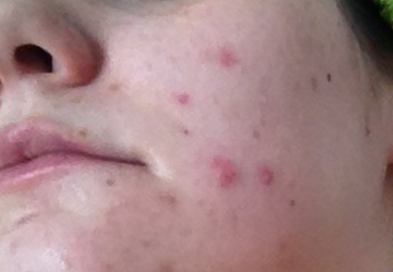 pode tomar vitamina d causar hematomas