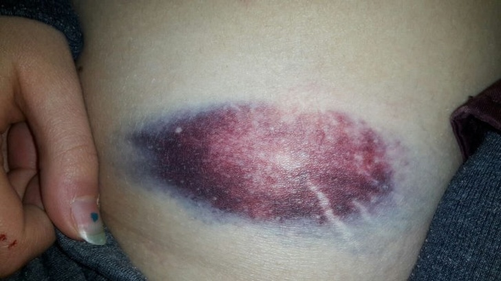 hematoma