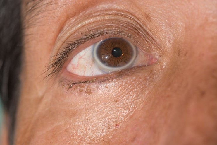 manchas de colesterol nos olhos manchas de colesterol nos olhos