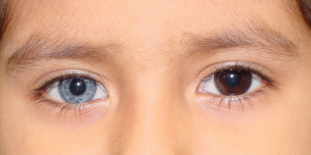 Heterocromia em seres humanos. (Fonte: Você Sabia/Reprodução)