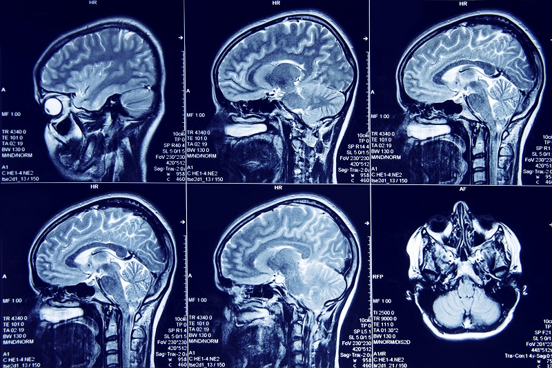 ressonância magnética dos voluntários