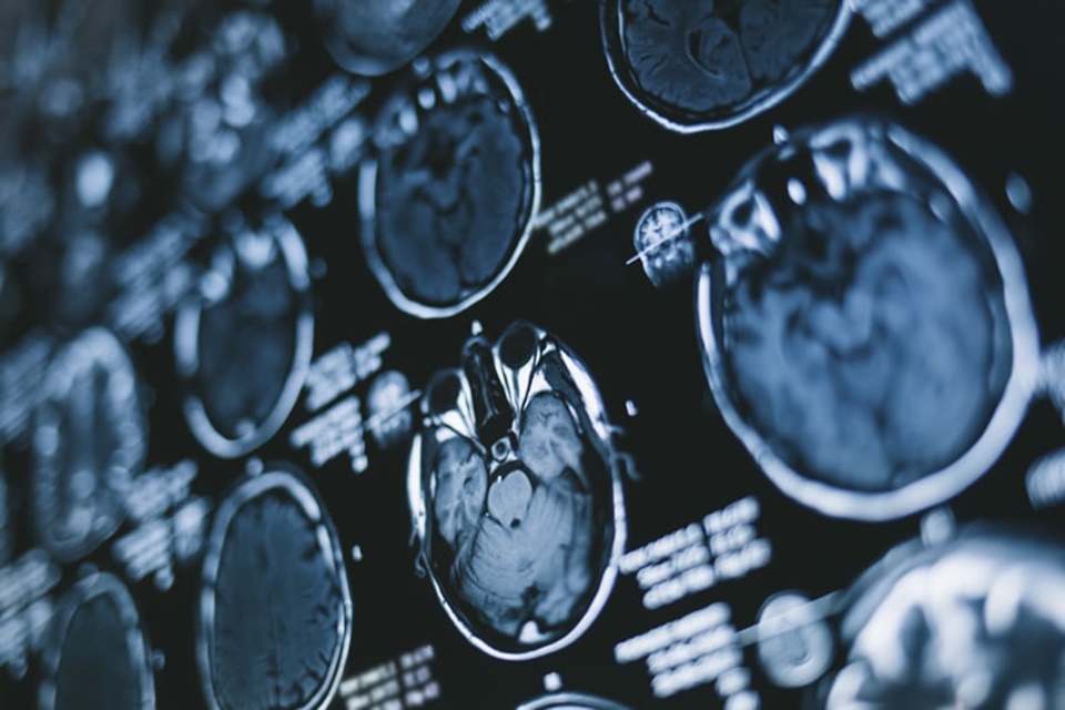Inteligência artificial ajuda a identificar hemorragia cerebral