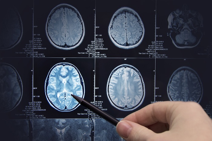imagem cerebral