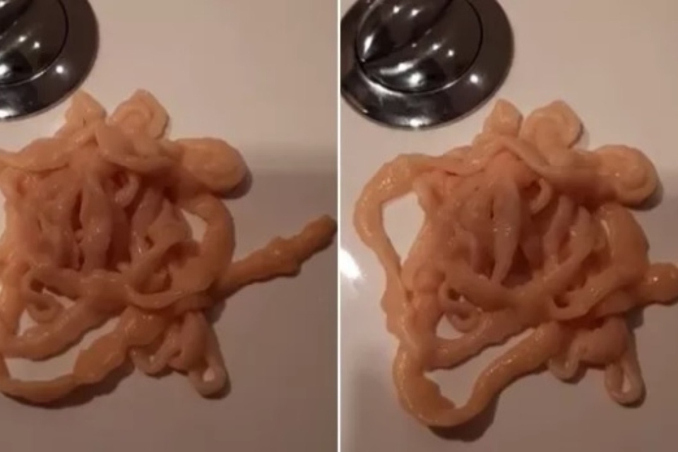 Homem retira tênia de 10 metros de seu próprio ânus