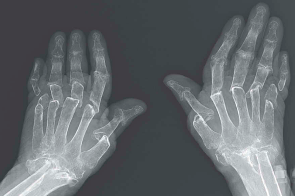 Mulher tem condição que resulta em raros dedos telescópicos