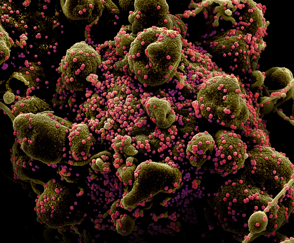 Micrografia eletrônica de varredura colorida de uma célula humana infectada pelo vírus SARS-CoV-2 (em rosa).