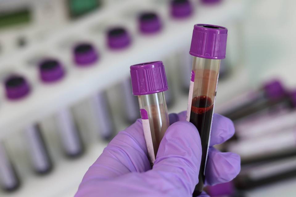 Estudo revela proteínas que ajudam a prever gravidade de covid-19
