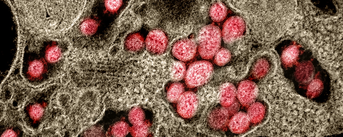 Imagem de: Confirmado 1º caso de reinfecção pelo novo coronavírus nos EUA