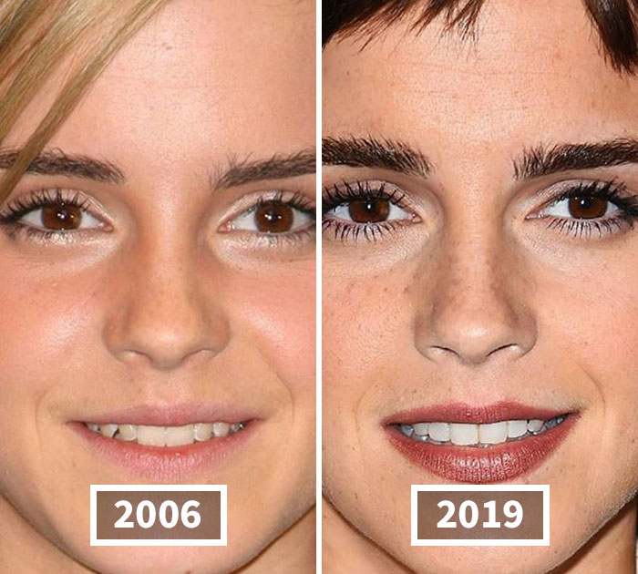 Fonte: celebbeforeafter/Instagram/Reprodução