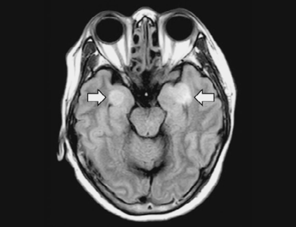 Brain image of an infected woman who developed encephalitis, with damage to brain tissues (arrows).