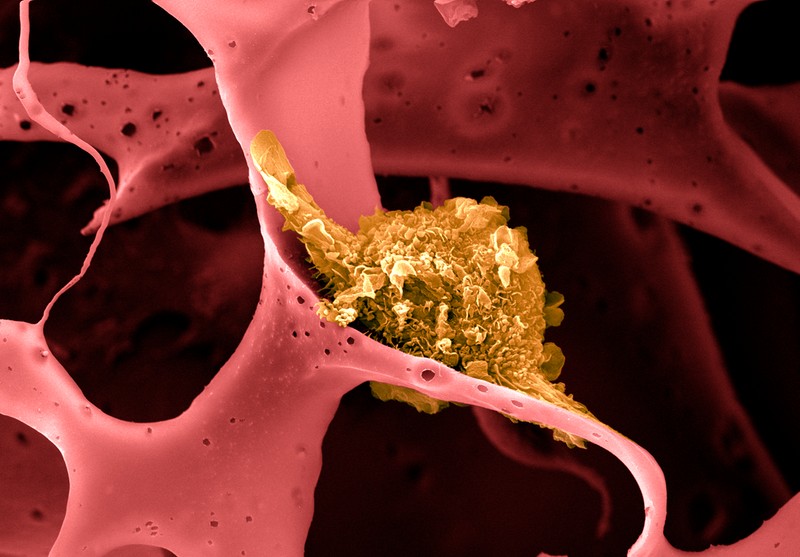 Lymphocytes (in yellow) use tumor antigens to trigger an immune system response against it.