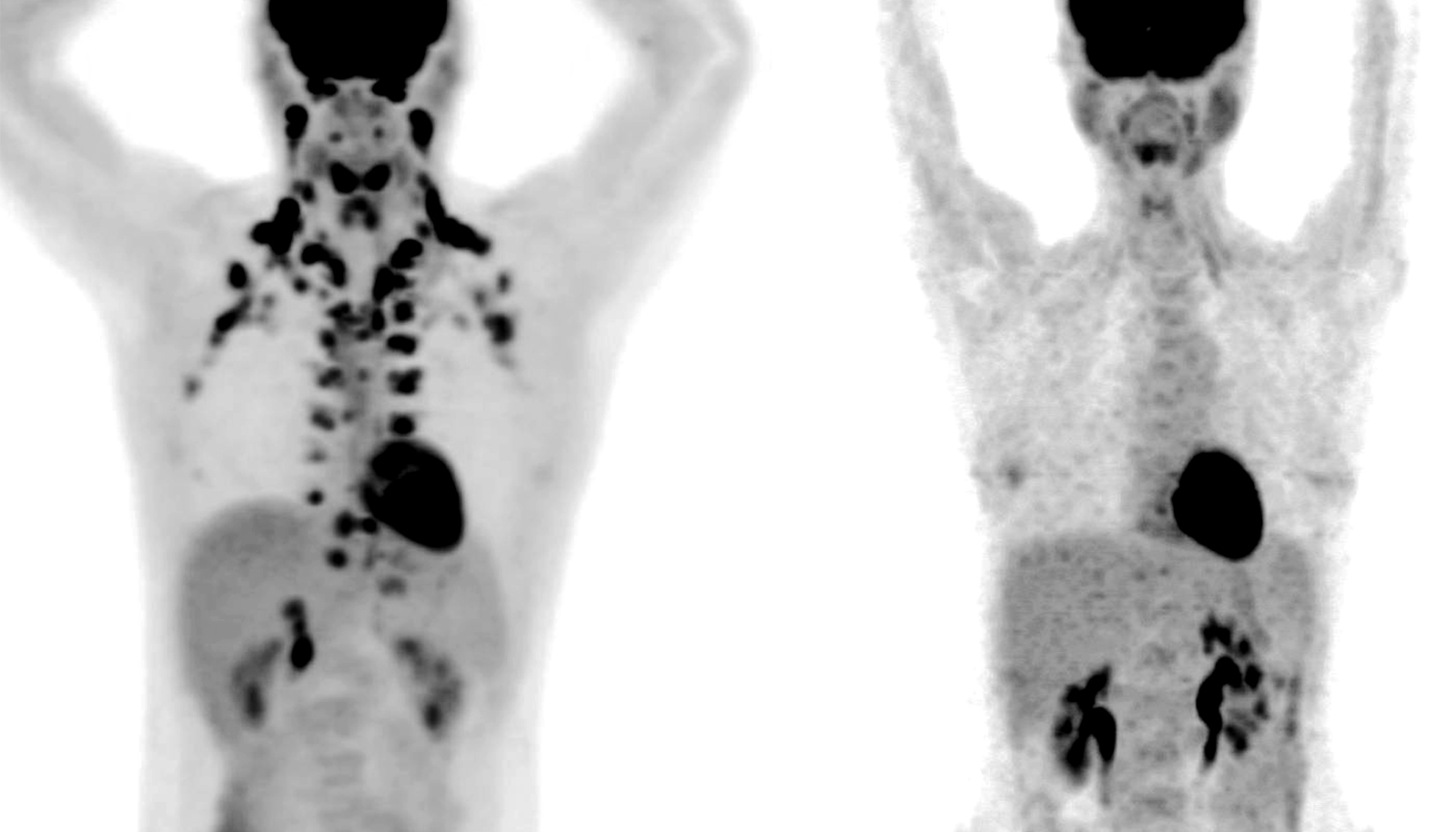 (Fonte: Memorial Sloan Kettering Cancer Center/Andreas G. Wibmer/Heiko Schöder/Reprodução)