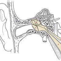Aparelho atuará no tensor do tímpano no ouvido interno