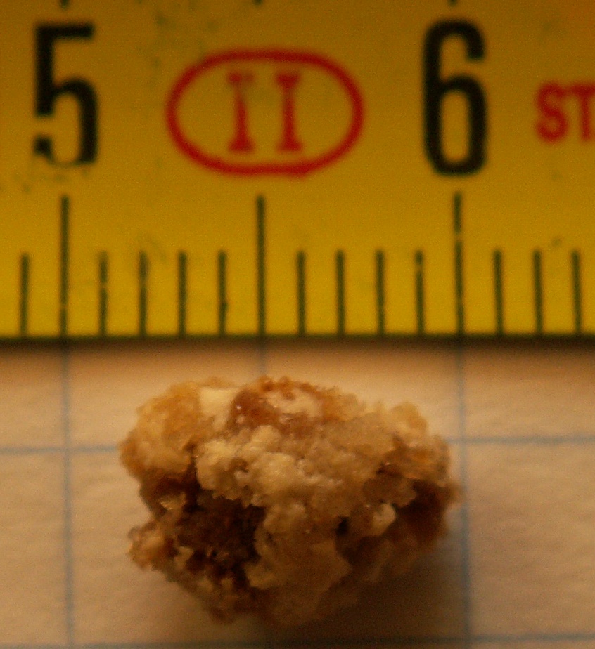 Um cálculo renal (Imagem: Wikimedia Commons)