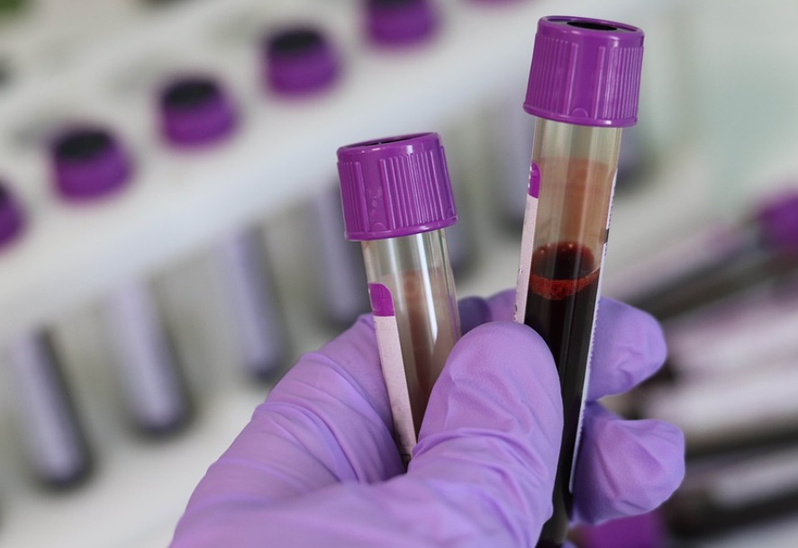 Cientistas encontram moléculas no sangue que indicam demência