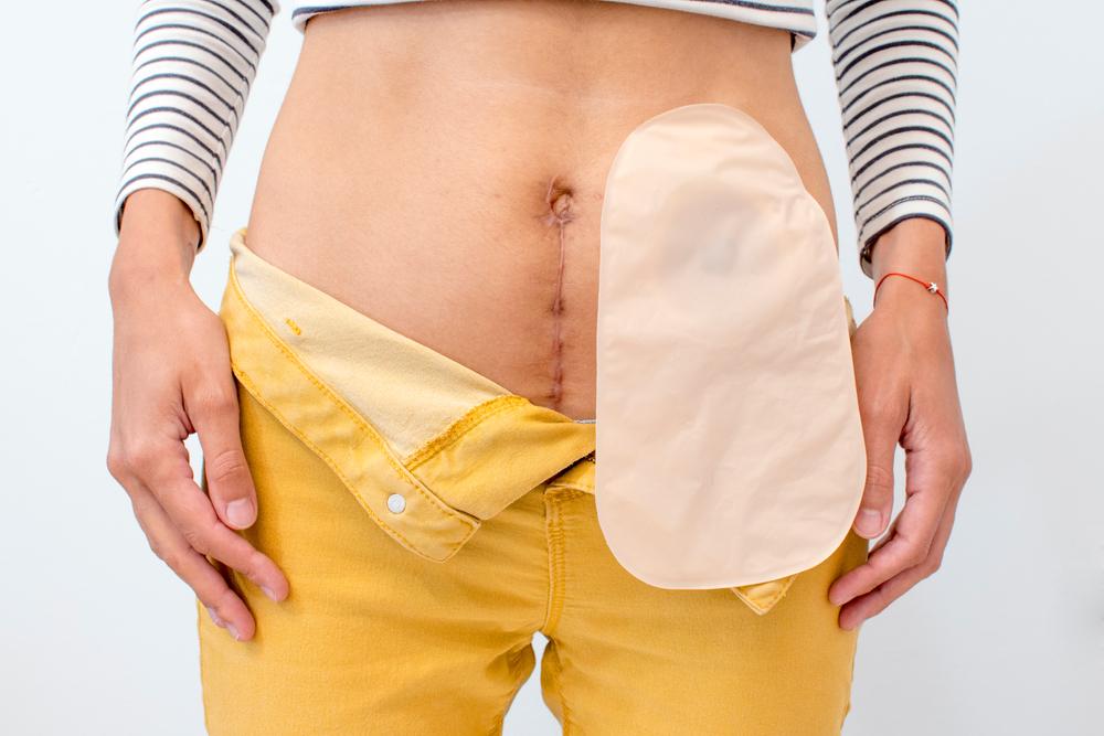 Crohn's disease is an inflammation of the gastrointestinal tract that, in severe cases, can lead to the use of a colostomy bag (Source: Shutterstock/Reproduction)