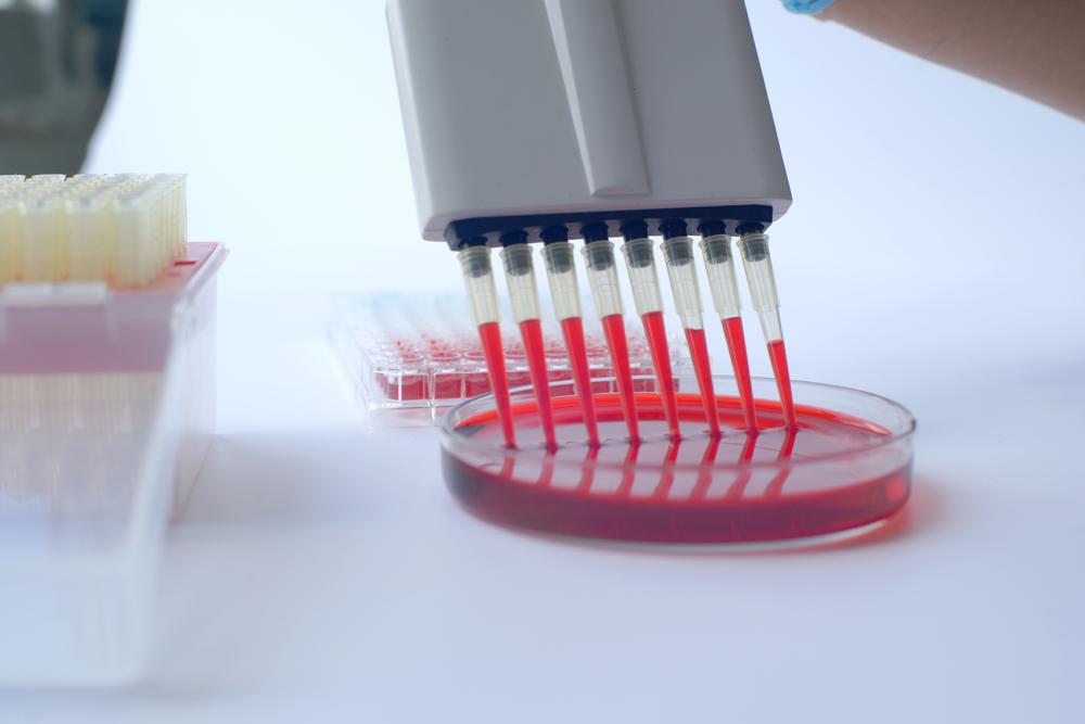 A blood test can help diagnose immunosuppression.  (Source: Shutterstock/Choksawatdikorn)