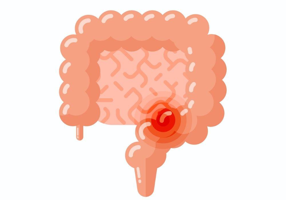 Essa é uma condição que se caracteriza pelo impedimento físico da passagem de fezes e gases no intestino.