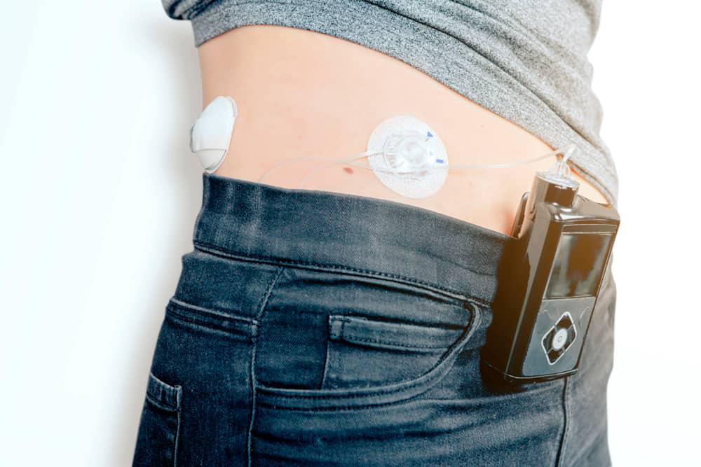 O pâncreas aritficial conta com um sensor em tempo real de glicemia e um dispositivo responsável por controlar a liberação dosada de insulina (Fonte: NIH/Reprodução)