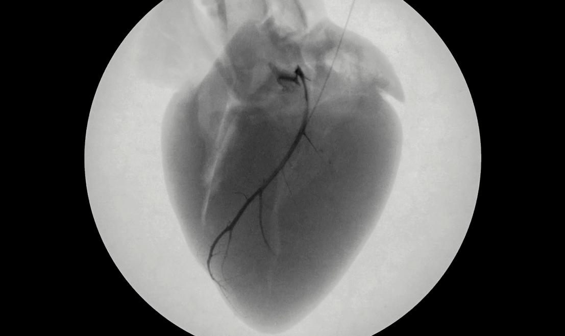 Fio injetável pode evitar mortes causadas por arritmia cardíaca