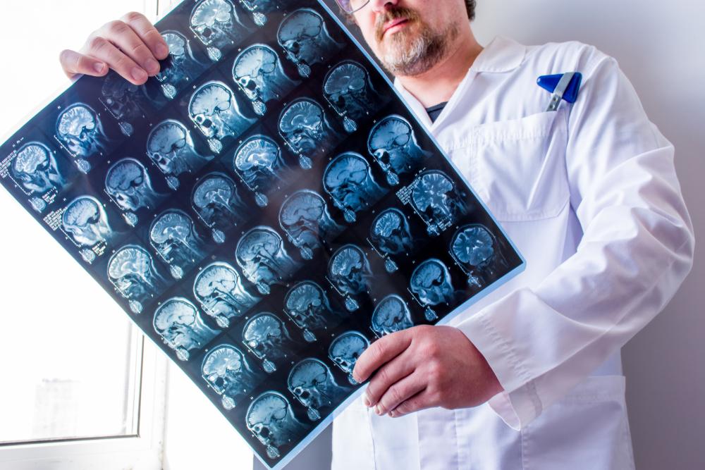 Imaging tests help diagnose multiple sclerosis