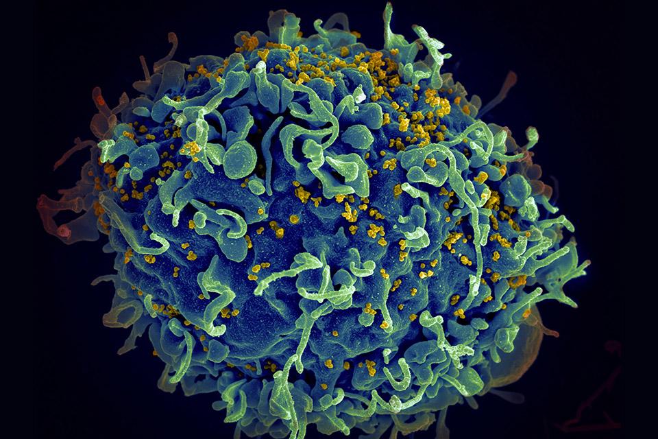 Técnica que usa edição genética mostra potencial para virar cura do HIV