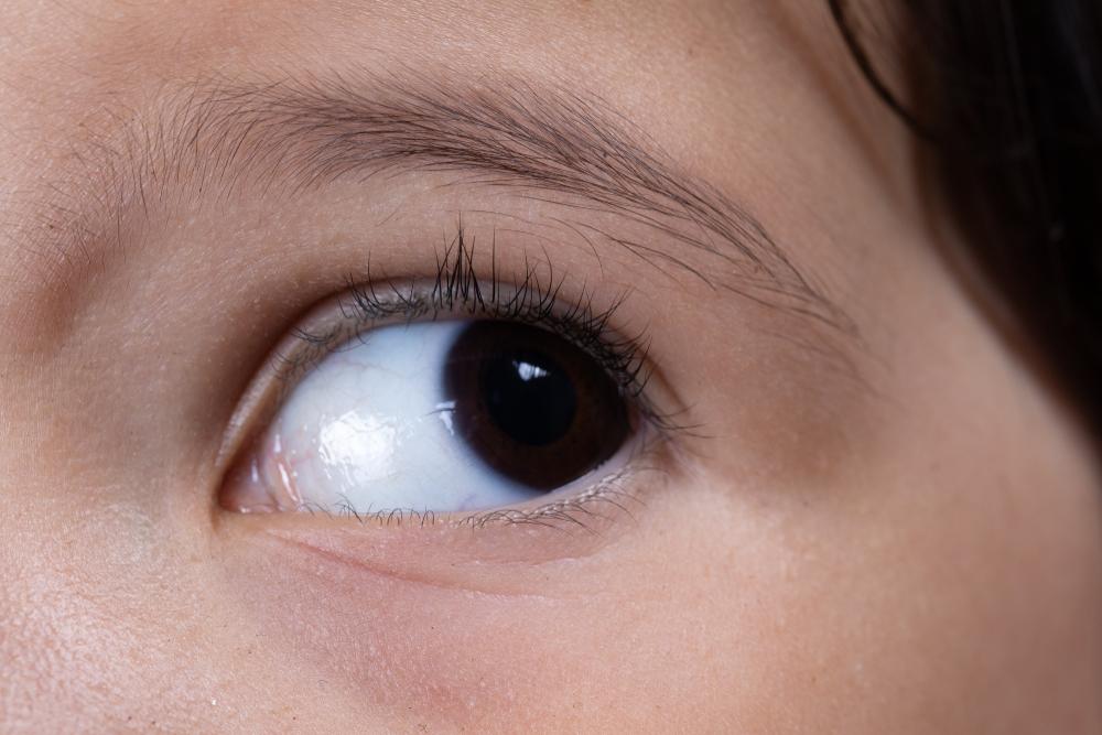 O que é nistagmo, doença dos olhos que limita a visão