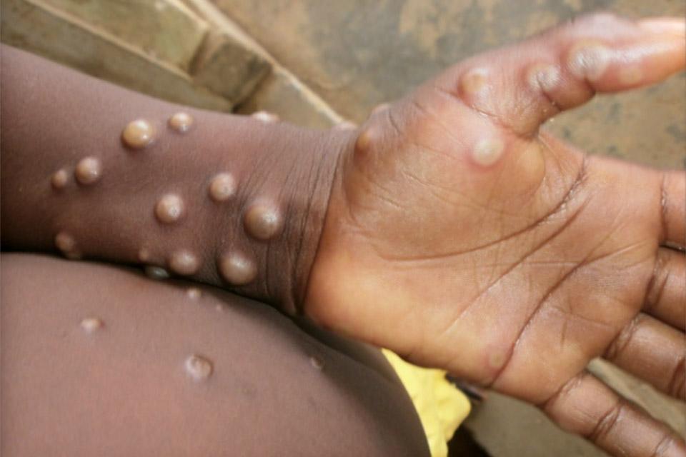 Surto de varíola dos macacos coloca EUA e Europa em estado de alerta