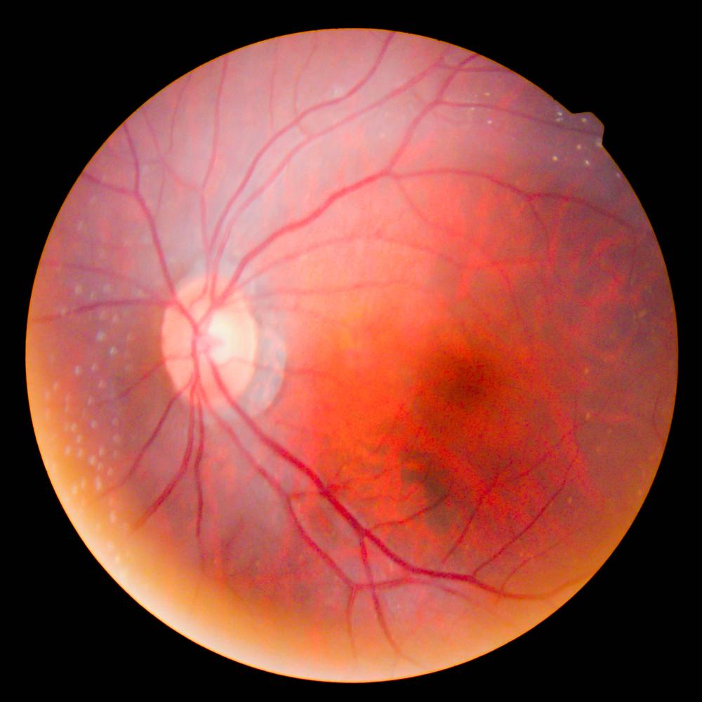 Padrão de vascularização da retina