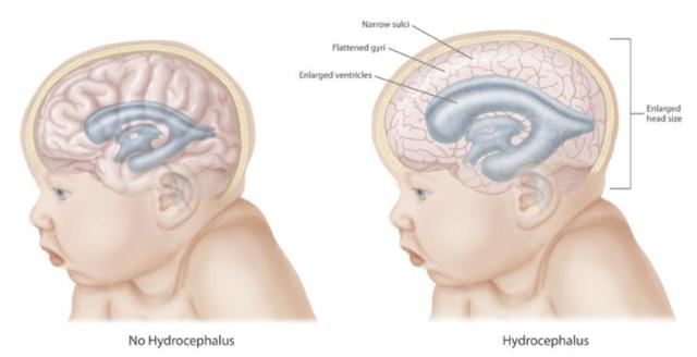 Além do inchaço, hidrocefalia causa deformação do crânio