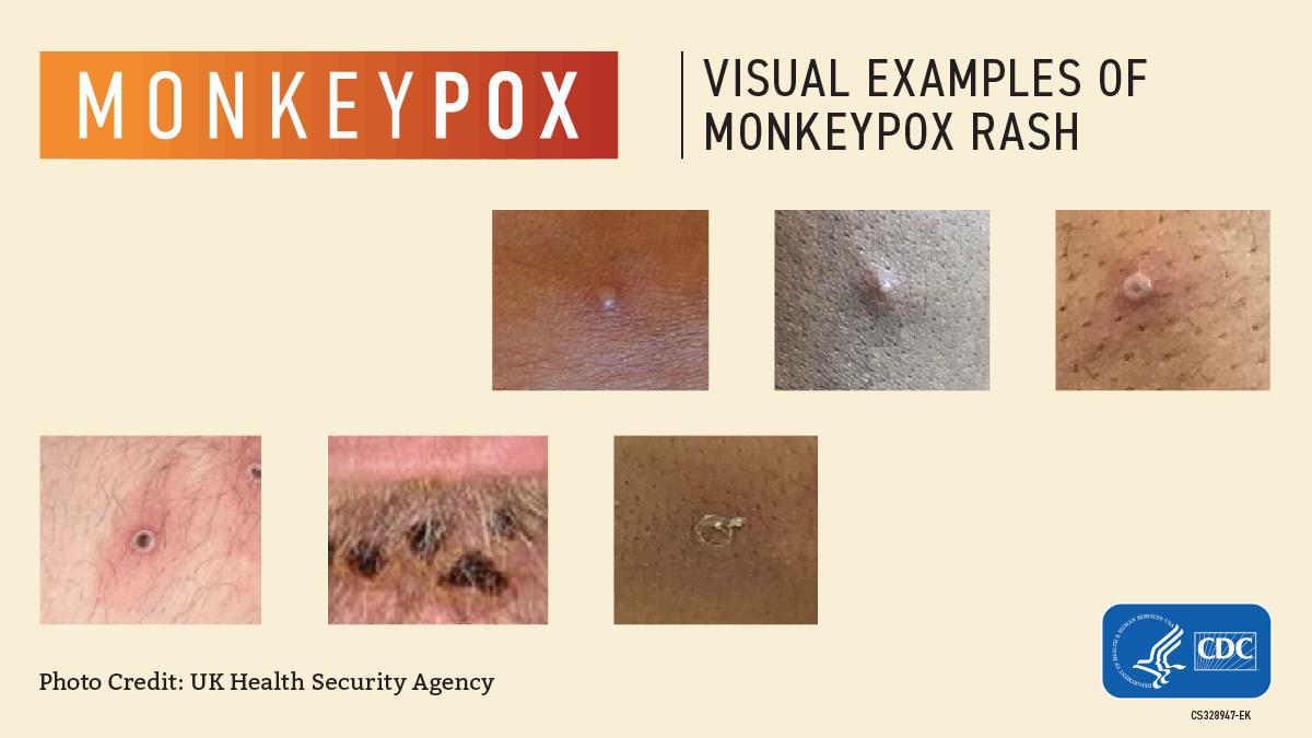 The picture shows examples of skin rashes caused by the monkeypox virus.