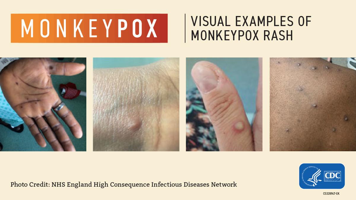 Picture shows examples of wounds caused by monkey pox