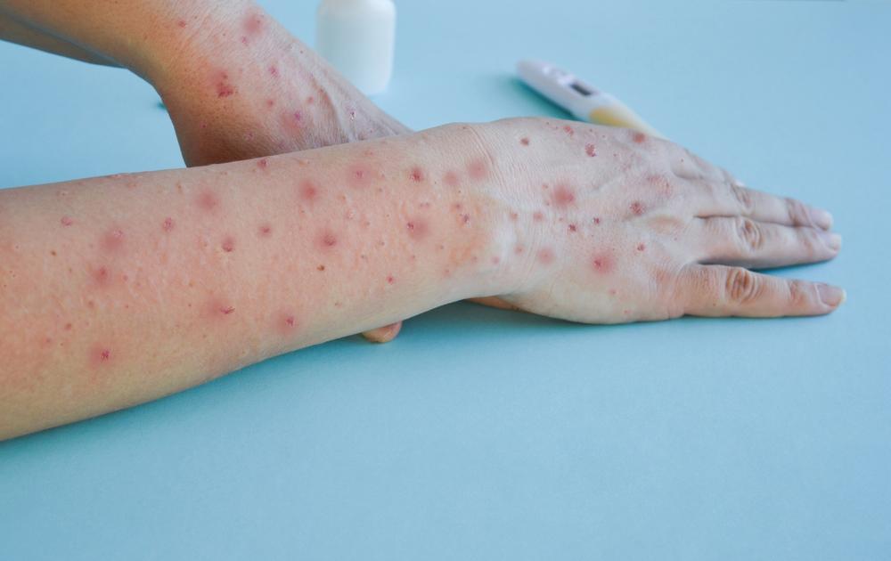 Mais de 4.470 casos de monkeypox foram registrados no Brasil, até o momento.