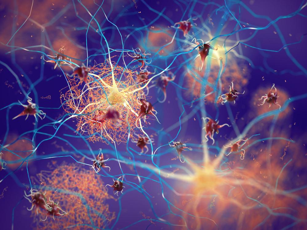 Graças a ação errônea dessas duas proteínas, os neurônios morrem, e com isso, os sintomas característicos e progressivos do Alzheimer se iniciam.