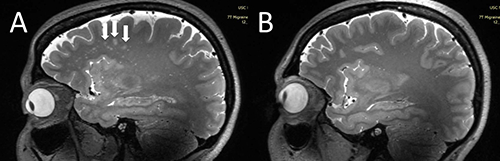 Differences shown by arrows in a migraine brain on the left and a healthy brain on the right.