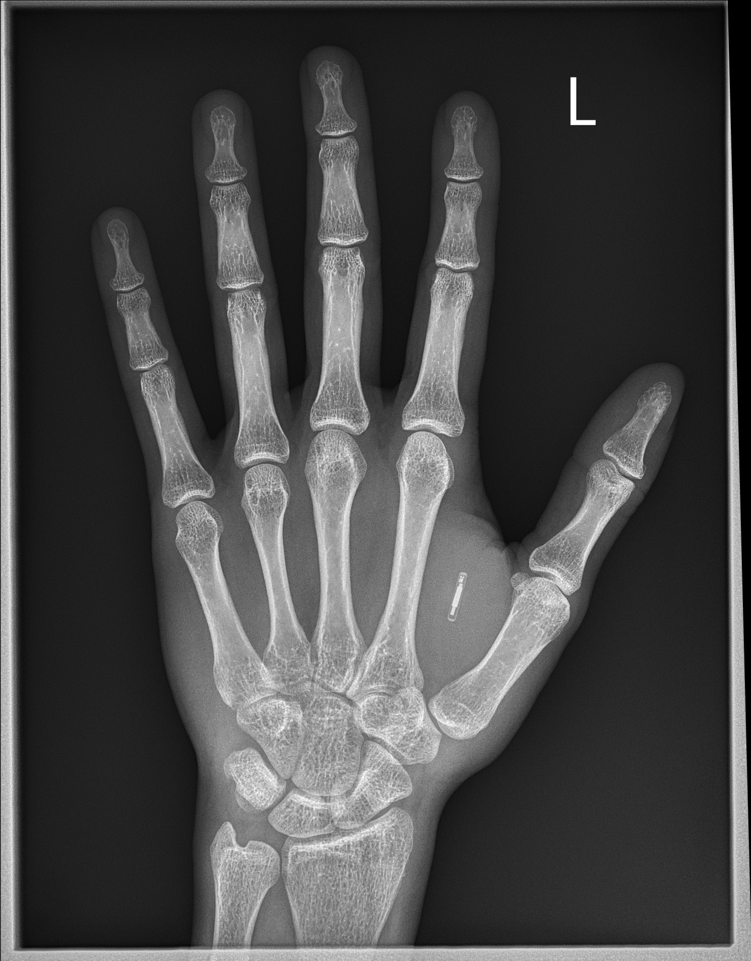 Radiofrequency biochips placed between the thumb and forefinger are among the most popular (Source: Wikimedia Commons/WCusr2019)