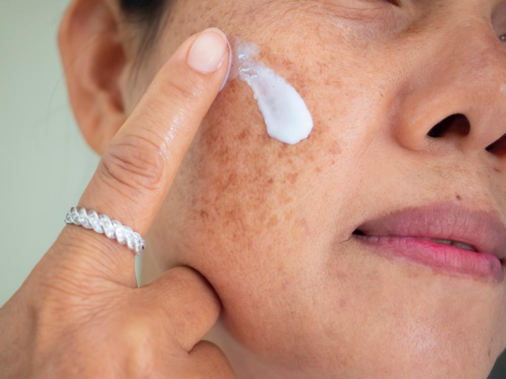 Creams based on hydroquinone, glycolic acid, retinoic acid, and azelaic acid often help remove blemishes.