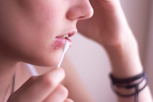 A infecção pelo vírus da herpes pode afetar a região bucal, genital e a pele em outras partes do corpo