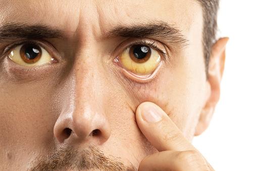 Os olhos amarelos são um sintoma de hepatites virais. (Fonte: GettyImages/Reprodução)