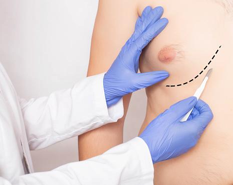 A cirurgia plástica é a última opção para o tratamento do crescimento das mamas nos homens. (Fonte: GettyImages/Reprodução)